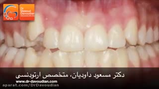 دندان نیش بیرون زده | دکتر مسعود داوودیان لیزر فرکشنال