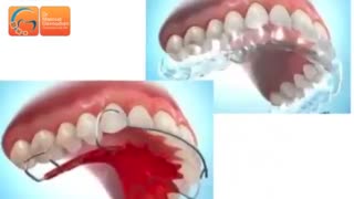 نگهدارنده ارتودنسی | دکتر مسعود داوودیان پاکسازی پوست