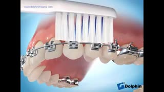 مسواک ارتودنسی | دکتر مسعود داودیان پیلینگ