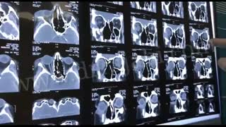 خارج کردن تومور از کاسه چشم بیمار 60 ساله