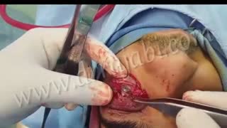 شکستگی کاسه چشم در اثر تصادف در جوان 22 ساله و جراحی آن