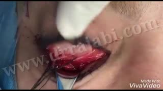شکستگی دیواره پایین کاسه چشم و جراحی آن
