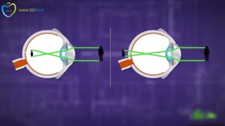 آیا عینک زدن باعث ضعیف شدن چشم ها می شود؟ (به زبان فارسی در سیب تل)
