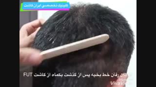 از بین رفتن خط بخیه پس از گذشت یکماه از کاشت به روش FUT