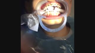 نحوه چسباندن براکت