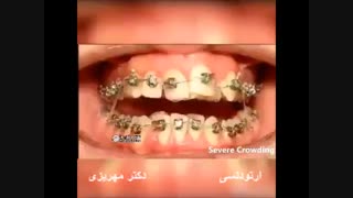تغییرات حین درمان توسط متخصص ارتودنسی