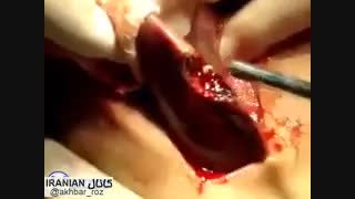 عاقبت مصرف سوسیس و کالباس