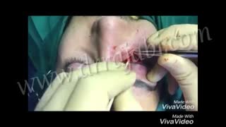 رترکشن یا کشیدگی پلک تحتانی به سمت پایین به دنبال جراحی