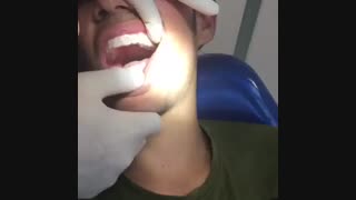 تحویل پلاک نگهدارنده شفاف جهت حفظ نتایج درمان ارتودنسی