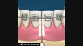 نحوه استفاده از مسواک بین دندانی ارتودنسی، دکتر آصفی
