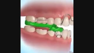 درمان هدایت رشدی عقب بودن فک، دکتر سهراب آصفی