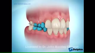 رفع مشکل تنگی فک بالا، دکتر سهراب آصفی
