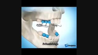 درمان عقب بودن فک بالا توسط فیس ماسک، دکتر آصفی