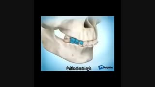 درمان جلو بودن فک بالا توسط هدگیر، دکتر آصفی