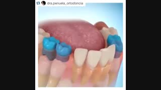 کشیدن سریالی دندان در طی رویش دندانها، دکتر آصفی