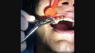 نحوه درآوردن براکت های ارتودنسی