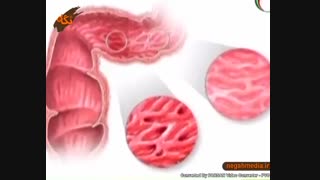 سرطان روده بزرگ