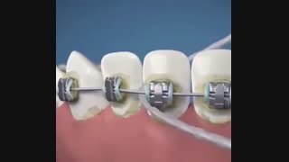 نحوه نخ دندان کشیدن ارتودنسی، دکتر آصفی