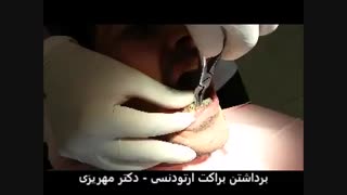برداشتن براکت های فلزی بعد از ارتودنسی