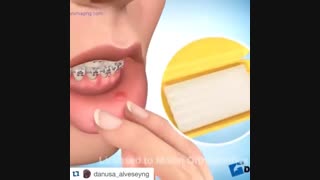 نحوه استفاده از موم ارتودنسی حین آزردگی های درمان دکتر آصفی