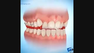 رفع مشکل جلو بودن فک پایین با پلاک متحرک ارتودنسی، دکتر آصفی