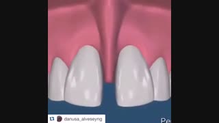 جراحی فرنوم  حین بستن فضای بین دندانهای جلو، دکتر سهراب آصفی