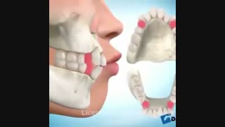 ارتودنسی نامرتبی دندانها با کشیدن دندان، دکتر سهراب آصفی