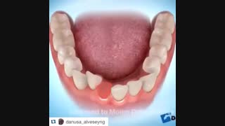 ارتودنسی با کشیدن یک دندان ثنایای پایین، دکتر سهراب آصفی