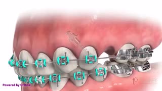 استفاده از مینی اسکرو برای بستن فضای کشیدن دندان، دکتر سهراب آصفی