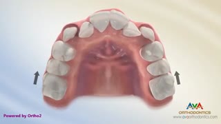 استفاده از فضانگهدار برای پیشگیری از مشکلات ارتودنسی، دکتر سهراب آصفی