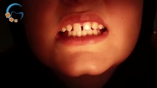 درمان دندان های غایب با ارتودنسی | دکتر مسعود داوودیان