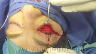 جراحی بیرون زدگی کره چشم