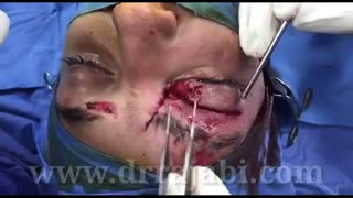 ترمیم پارگی کامل پلک بالا