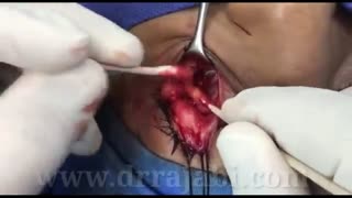 توده عروقی در اربیت با برآمدگی در پشت پلک تحتانی