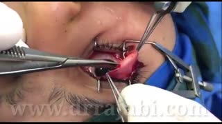 تومور مادرزادی لیپودرموئید در یک دخترخانم ٦ ساله