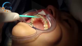 دستگاه فانکشنال ارتودنسی  | دکتر مسعود داوودیان