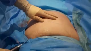 لیپوماتیک شکم و پهلو+نتیجه لیپوماتیک قبل و بعد