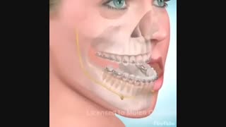 درمان جراحی 2 فک مشکل جلو بودن فک پایین- دکترسهراب آصفی