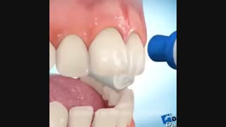 روند چسباندن براکت های ارتودنسی در شروع درمان- دکتر سهراب آصفی