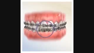 اصلاح انحراف خط وسط دندانها توسط الاستیک های فکی - دکتر سهراب آصفی