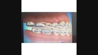 اصلاح جلو بودن دندانهای فک پایین با الاستیک- دکتر سهراب آصفی