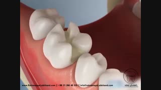 اینله دندان