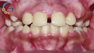 درمان ارتودنسی بدون کشیدن دندان | دکتر مسعود داوودیان