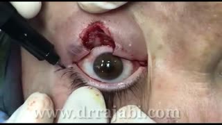 جراحی تومور بازال سل کارسینوما در پلک پایین