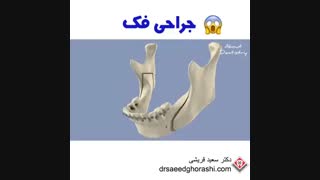 جراحی فک - دکتر سعید قریشی لیزر مو