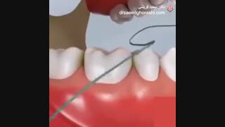 نخ دندان- دکتر سعید قریشی لیفت صورت