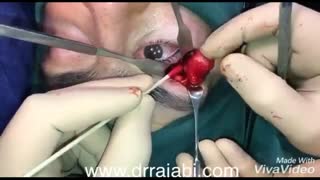 تومور بزرگ غده اشکی در کاسه چشم در آقای ٣٠ ساله