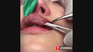 تخلیه پروتز لب