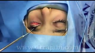 عقب رفتگی یا رترکشن مادرزادی پلک بالا در کودک ۴ ساله