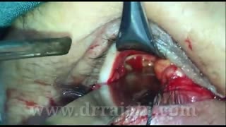 بیرون زدگی ناگهانی در چشم آقای ۵۲ ساله